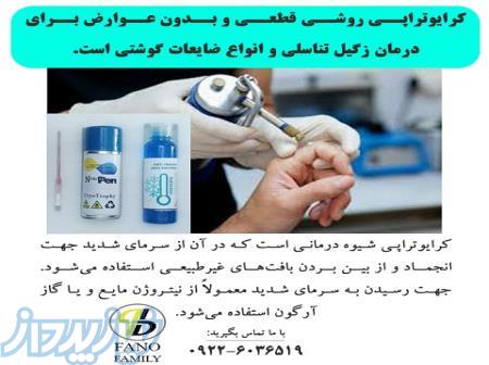 کرایوتراپی زگیل تناسلی یک روش قطعی و بدون عوارض است  