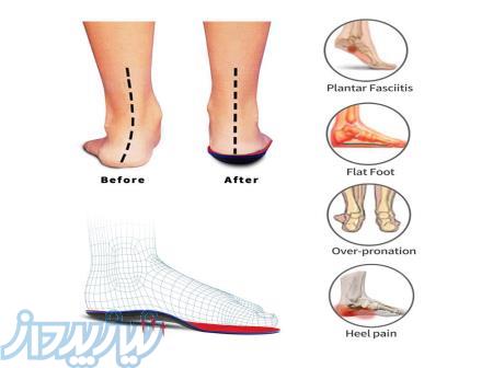 درمان زانوی پرانتزی ، کفش طبی در شهران 
