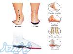 درمان زانوی پرانتزی ، کفش طبی در شهران 
